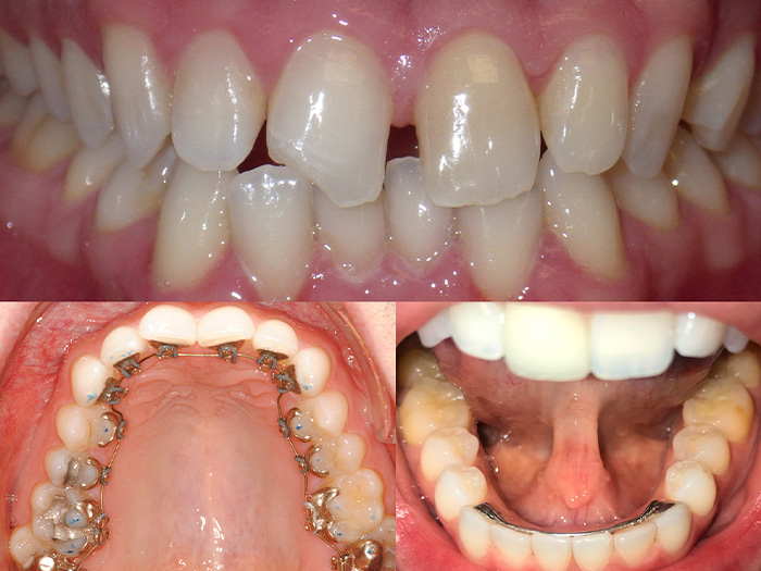 Mewing with braces results in before & after picture